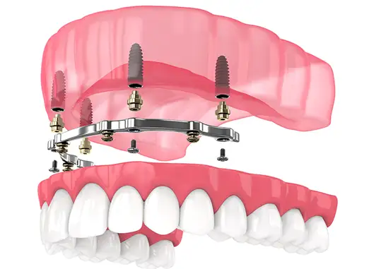 Dental ALL-ON-4 Implants
