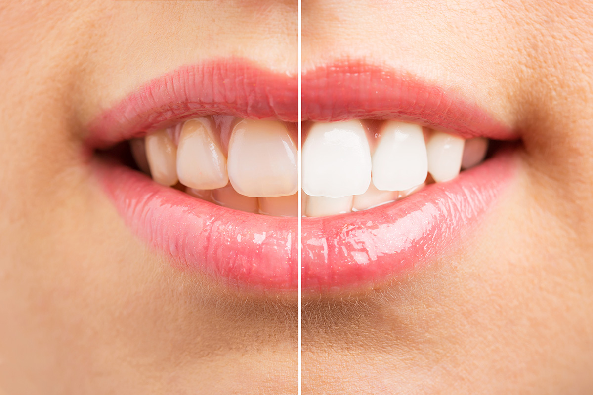 Before and after image of a teeth whitening.