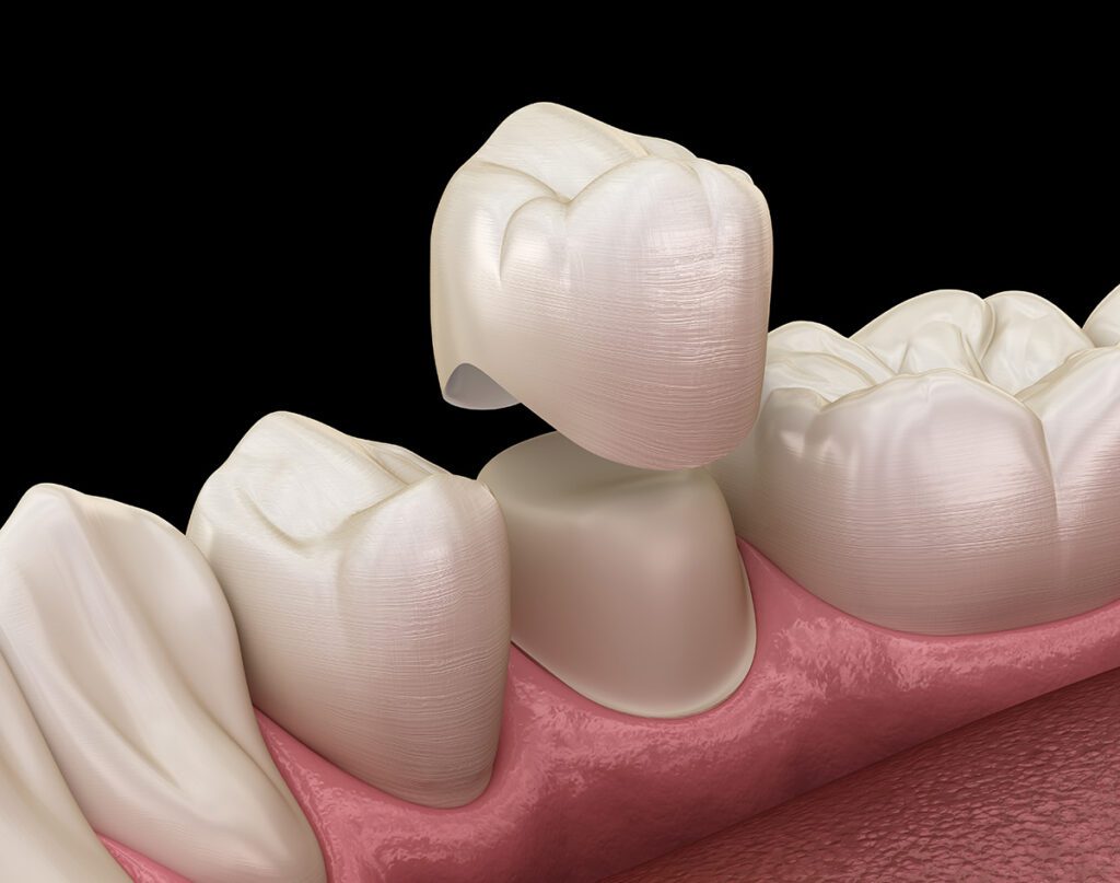 3D render of a dental crown being placed on a tooth.