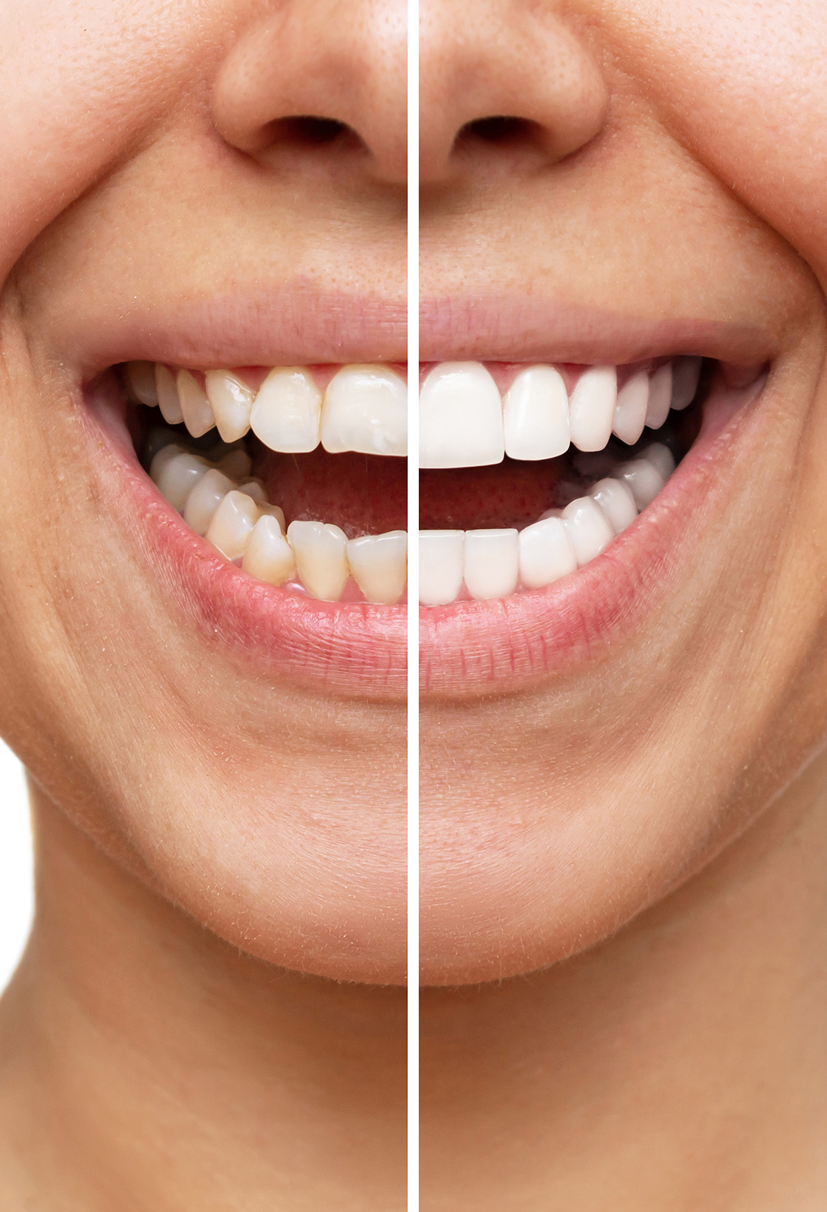 Image of a before and after of a young women smiling.